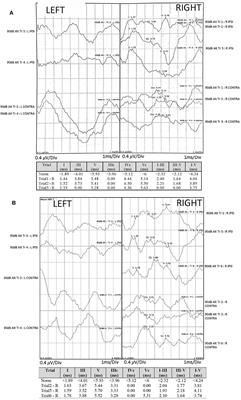 Case Report: Auditory Neuropathy and Central Auditory Processing Deficits in a Neuro-Otological Case-Study of Infratentorial Superficial Siderosis